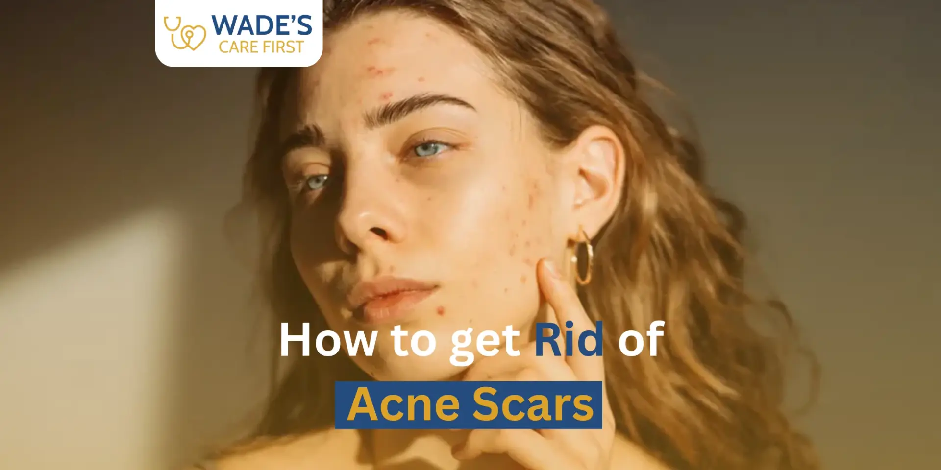 How to Get Rid of Acne Scars